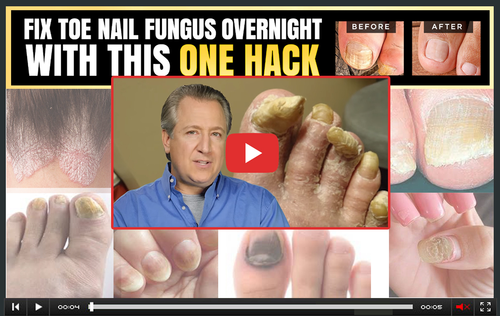 Fungus Hack Supplement Video